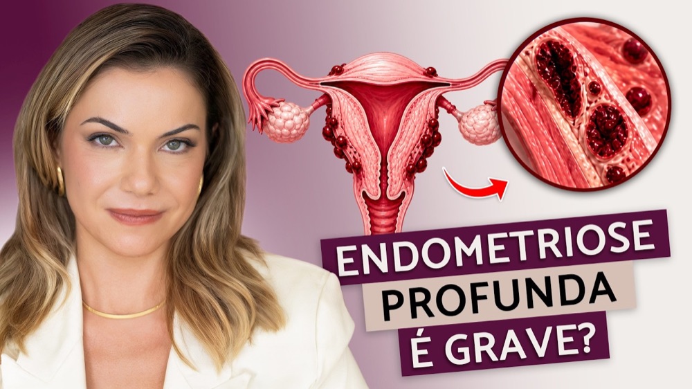 Capa do vídeo sobre endometriose profunda